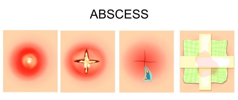 كيف يتم تطهير الخراج بعد فتحه