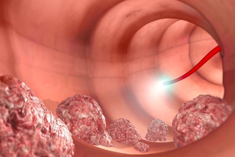هل القولون يسبب تغير لون البراز