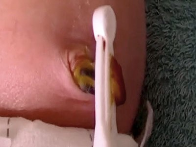 مراحل سقوط سرة الطفل