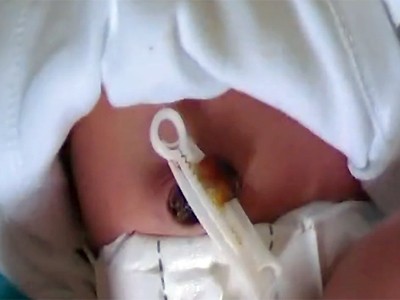 مراحل سقوط سرة الطفل