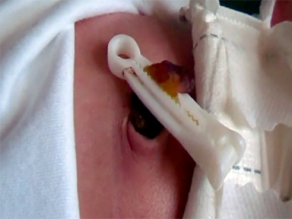 مراحل سقوط سرة الطفل