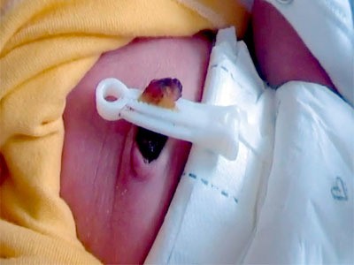 مراحل سقوط سرة الطفل