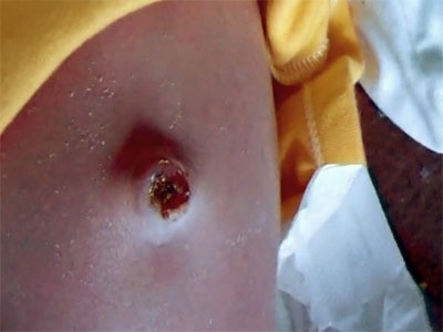 مراحل سقوط سرة الطفل