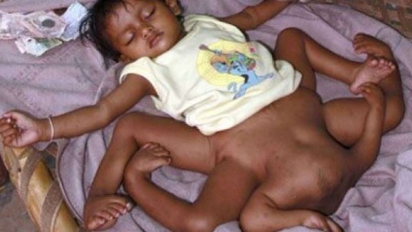 صور أنواع التوائم