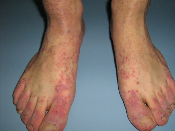 انواع مرض الحزاز بالصور