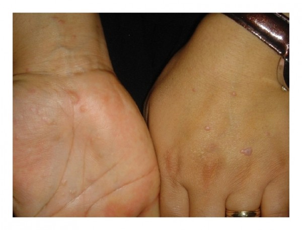 مرض الحزاز وانواعه بالصور