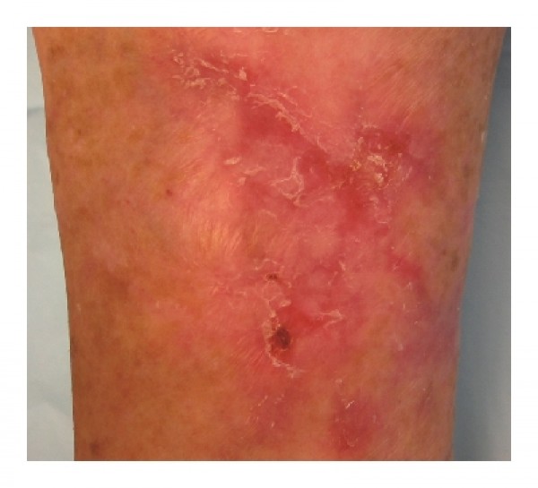 مرض الحزاز وانواعه بالصور