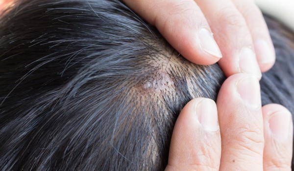 مرض الحزاز وانواعه بالصور