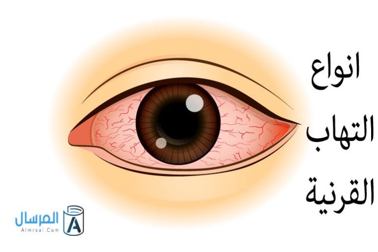 انواع التهاب القرنية
