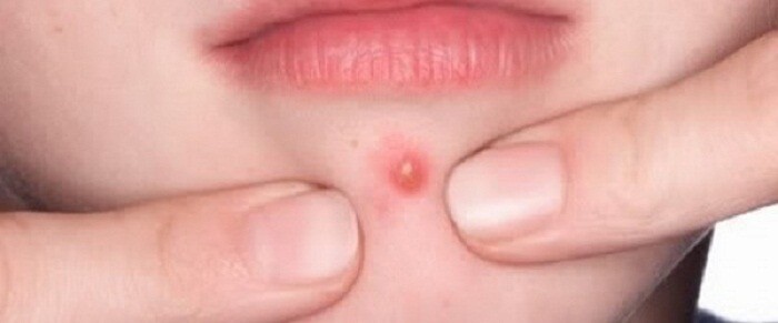 متى يحتاج الدمل إلى جراحة متى يحتاج الدمل إلى جراحة