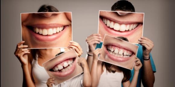 كم يدوم تبييض الأسنان كم يدوم تبييض الأسنان