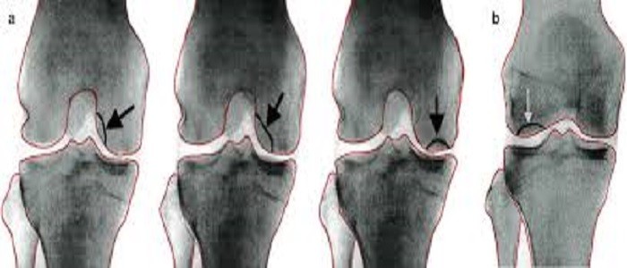 درجات خشونة الركبة