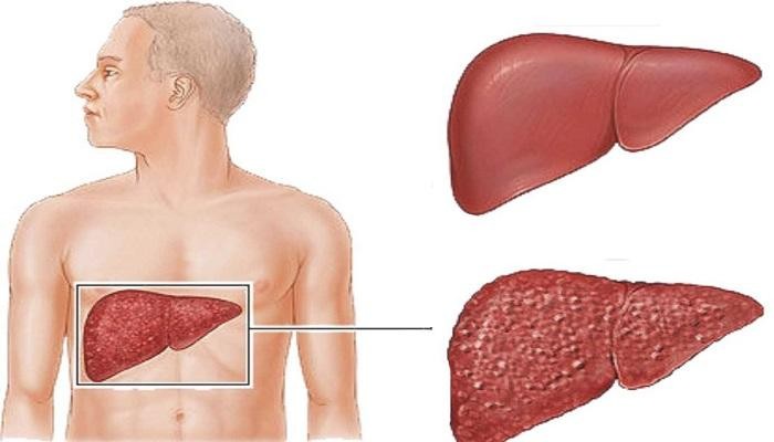 أنواع الفيروسات الكبدية أنواع الفيروسات الكبدية