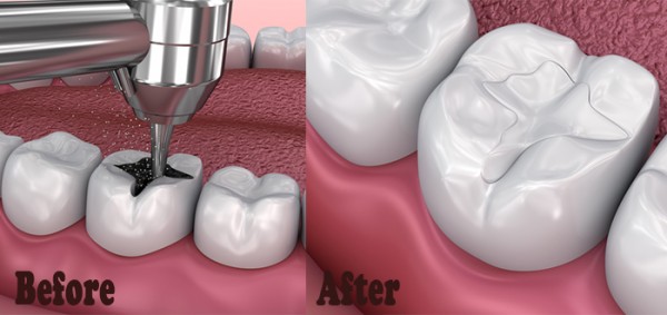 كيفية التعامل مع حشو الاسنان المؤقت
