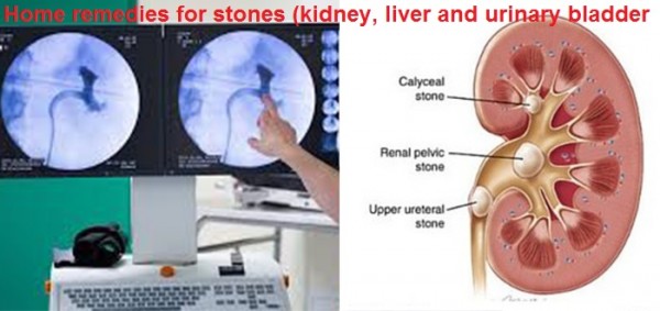 علاج حصوات الحالب في المنزل