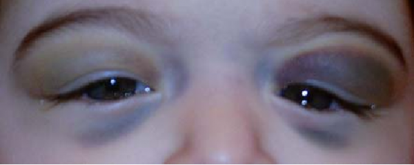 متلازمة عيون الباندا