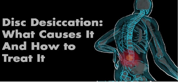جفاف القرص بالعمود الفقري