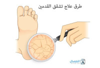 طرق علاج تشقق القدمين