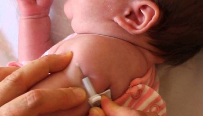 ماهو لقاح BCG