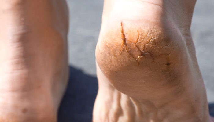 علاقة الكعوب المتشققة بنقص الفيتامينات