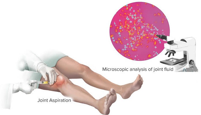 تحليل سائل المفاصل Synovial Fluid Analysis تحليل سائل المفاصل Synovial Fluid Analysis