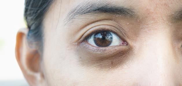 ما علاج السواد تحت العين