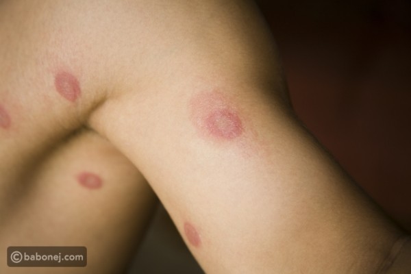 ما علاج القوباء الحلقية عند الأطفال وما أسبابها