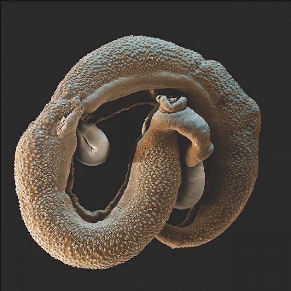 ما هي البلهارسيا