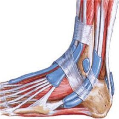 ما هو التهاب الاوتار المزمن