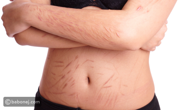 حروق الليزر أسبابها وعلاجها