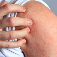 معلومات حول الهيستامين معلومات حول الهيستامين