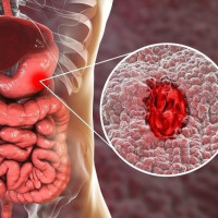 القرحة تعريفها أنواعها وعلاجها والفئات الأكثر إصابة بها