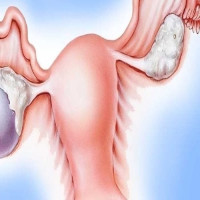 ما هي اسباب اكياس المبايض ما هي اسباب اكياس المبايض