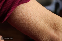 علاج جلد الوزة بطرق محتلفة وما هي أسبابه علاج جلد الوزة بطرق محتلفة وما هي أسبابه