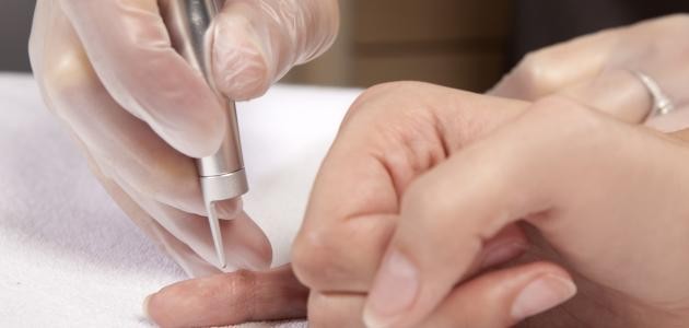 كيفية التخلص من الثآليل