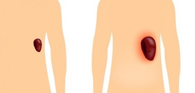 ما هو سبب تضخم الطحال ما هو سبب تضخم الطحال