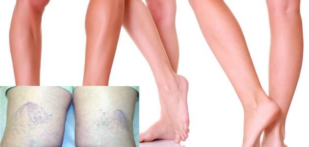 تمارين لعلاج تقوس الساقين تمارين لعلاج تقوس الساقين