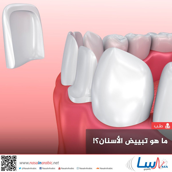 ما هو تبييض الأسنان؟!
 ما هو تبييض الأسنان؟!