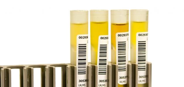 تشخيص مرض الزلال