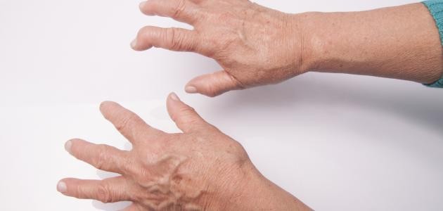 تشخيص الروماتيزم تشخيص الروماتيزم