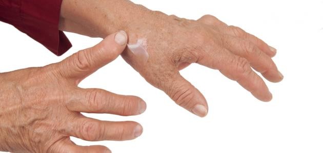 انتشار الروماتيزم و طريقة إمراضه انتشار الروماتيزم و طريقة إمراضه
