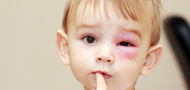 قرحة القرنية قرحة القرنية