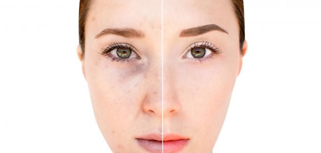 ما علاج تصبغات الوجه ما علاج تصبغات الوجه