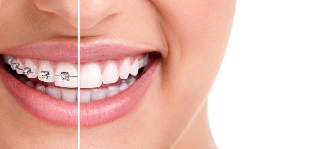 تقويم الأسنان ينحف تقويم الأسنان ينحف