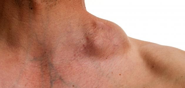 تضخم الغدد اللمفاوية تضخم الغدد اللمفاوية