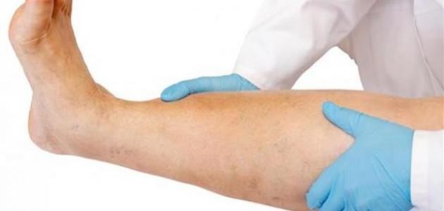 ما هي أعراض جلطة القدم ما هي أعراض جلطة القدم