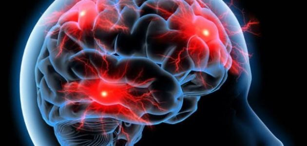 ما هو مرض الصرع ما هو مرض الصرع