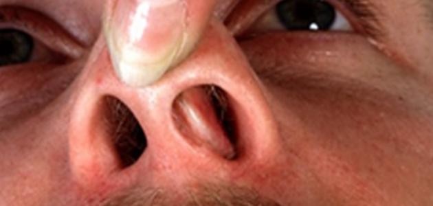 ما هي أعراض اللحمية في الأنف ما هي أعراض اللحمية في الأنف