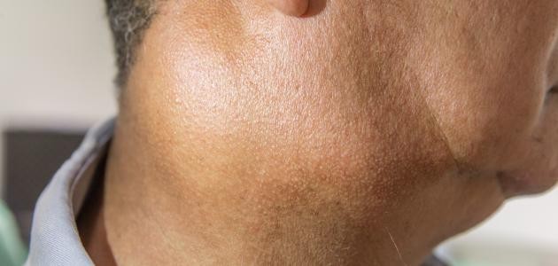 ما هي أعراض التهاب الغدة اللمفاوية