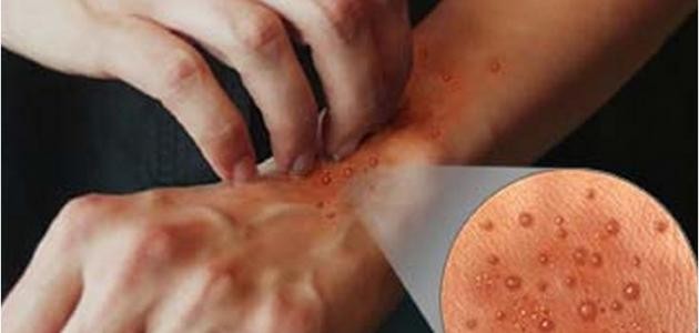 ما هي أعراض الجرب ما هي أعراض الجرب